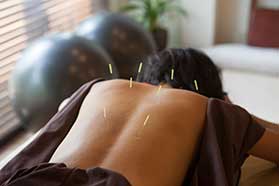 Acupuncture Clinic in West Hollywood, CA